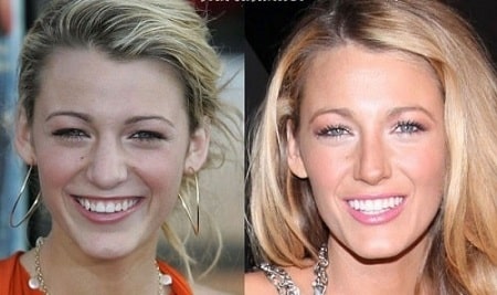 A before and after picture showing change in Blake Lively's eyelids.